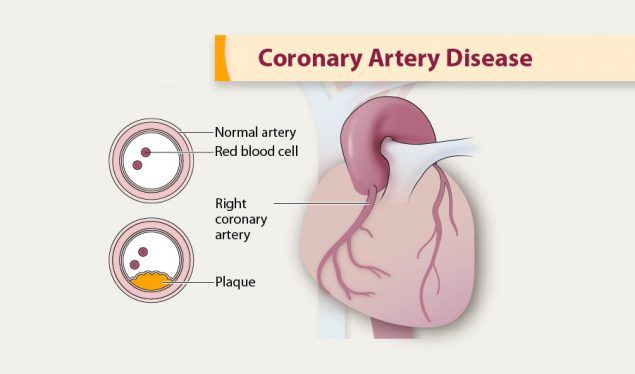 coronary artery disease